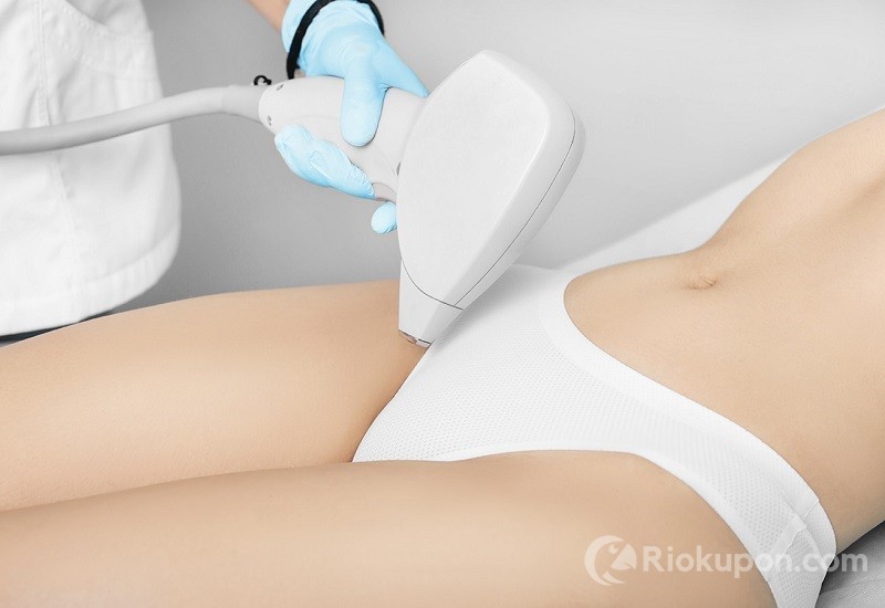 Hình minh họa về triệt lông vùng kín